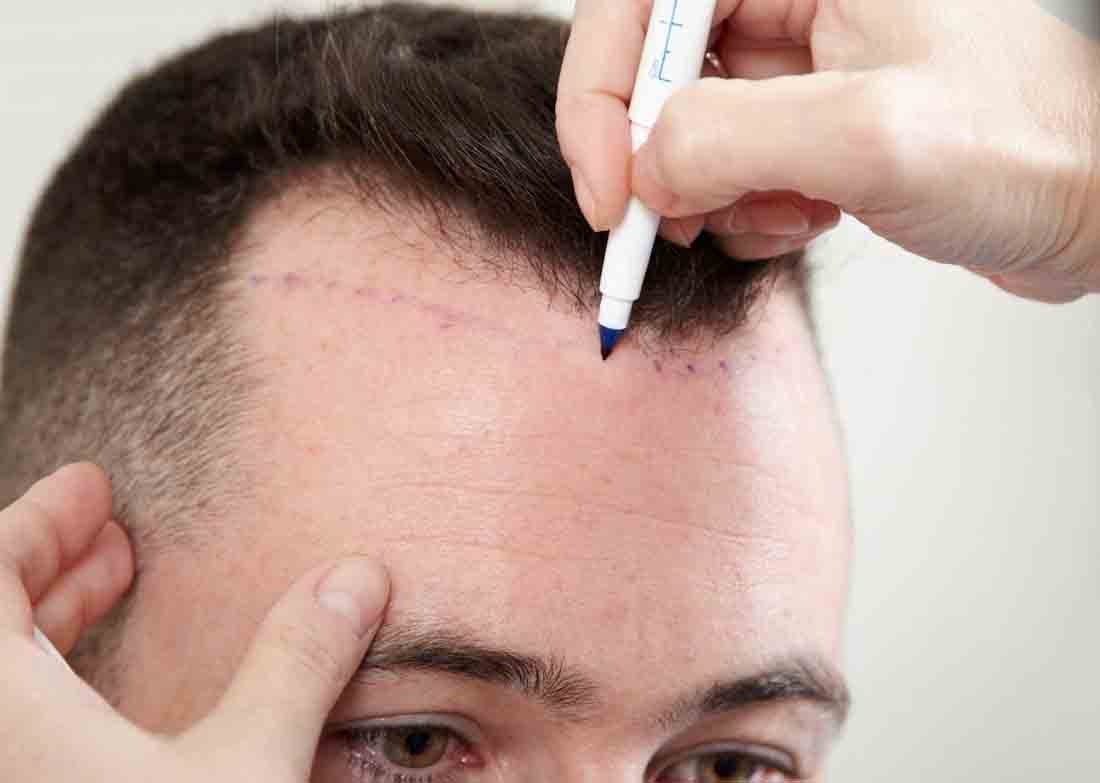 زراعة الشعر