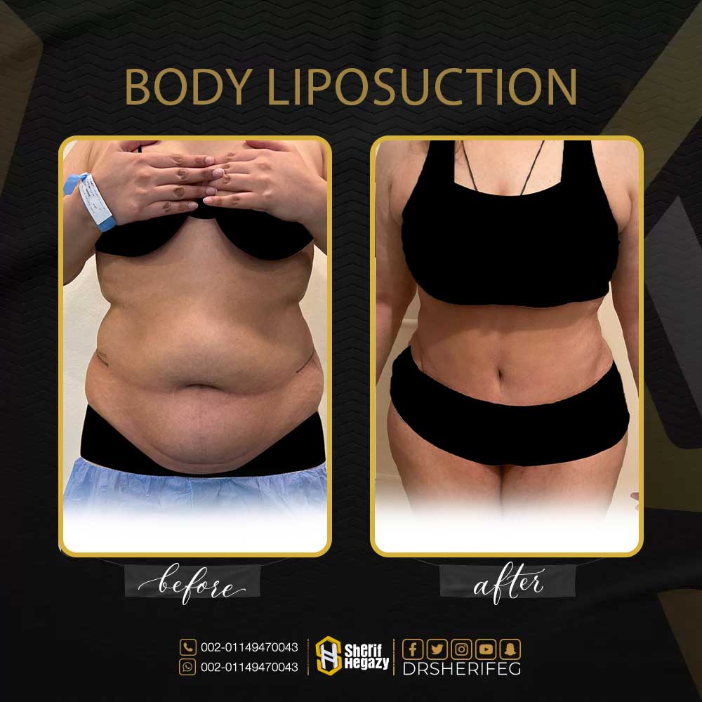 BODY LIPOSUCTION