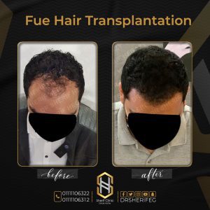 عدد بصيلات الشعر