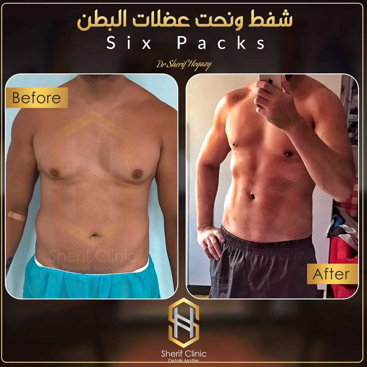 شفط ونحت عضلات البطن