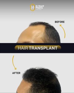 صورة قبل وبعد زراعة الشعر بالاقتطاف fue