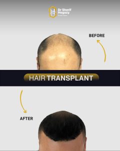 زراعة الشعر بالاقتطاف قبل وبعد