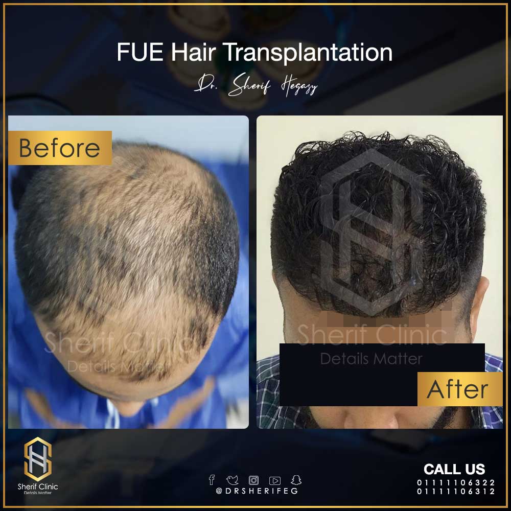 نتائج زراعة الشعر