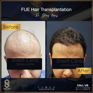زراعة الشعر للرجال
