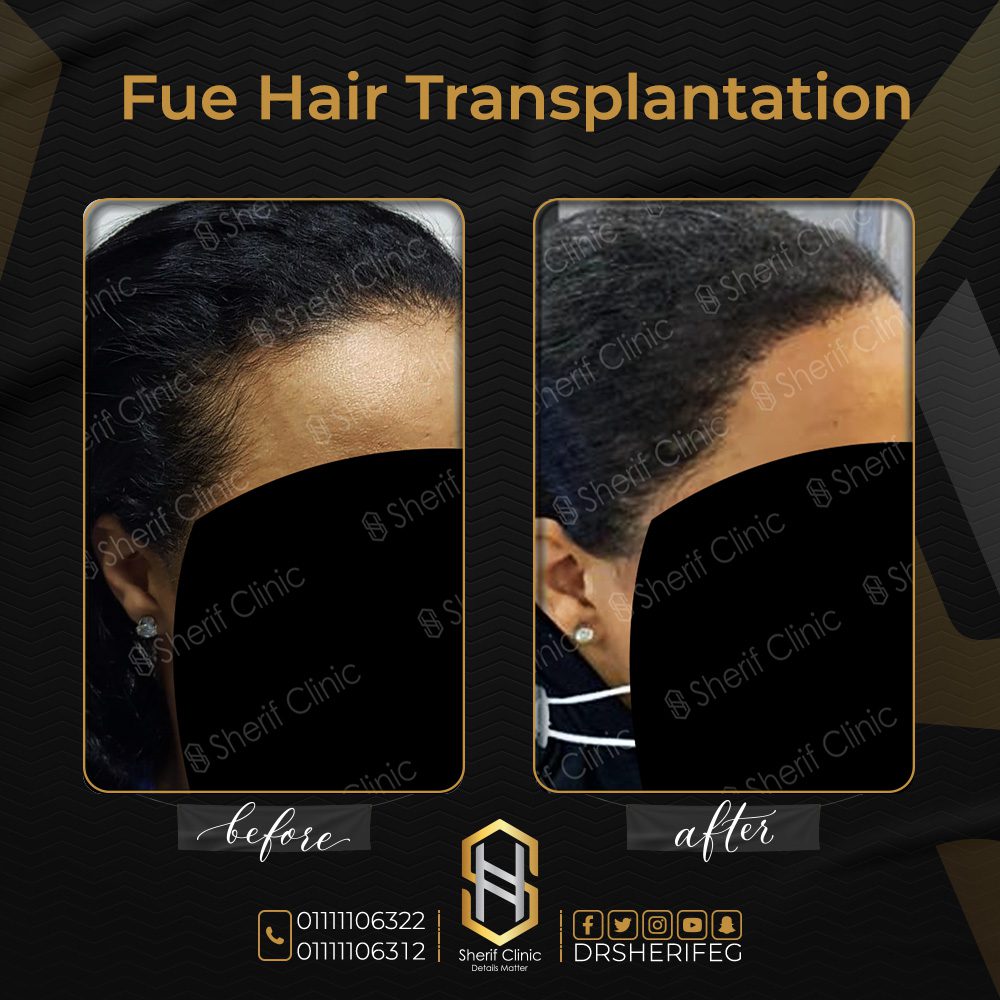 قبل وبعد زراعة الشعر للسيدات