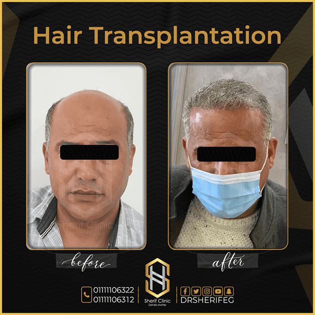 مراحل زراعة الشعر