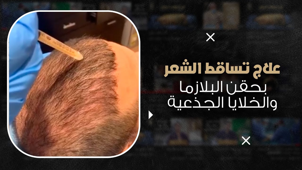 علاج تساقط الشعر بحقن البلازما والخلايا الجذعية