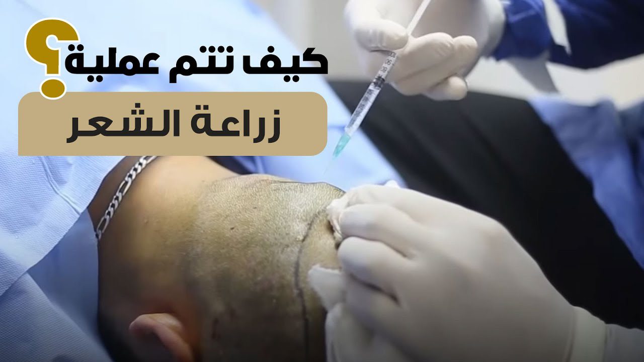 من داخل العمليات خطوات عملية زراعة الشعر