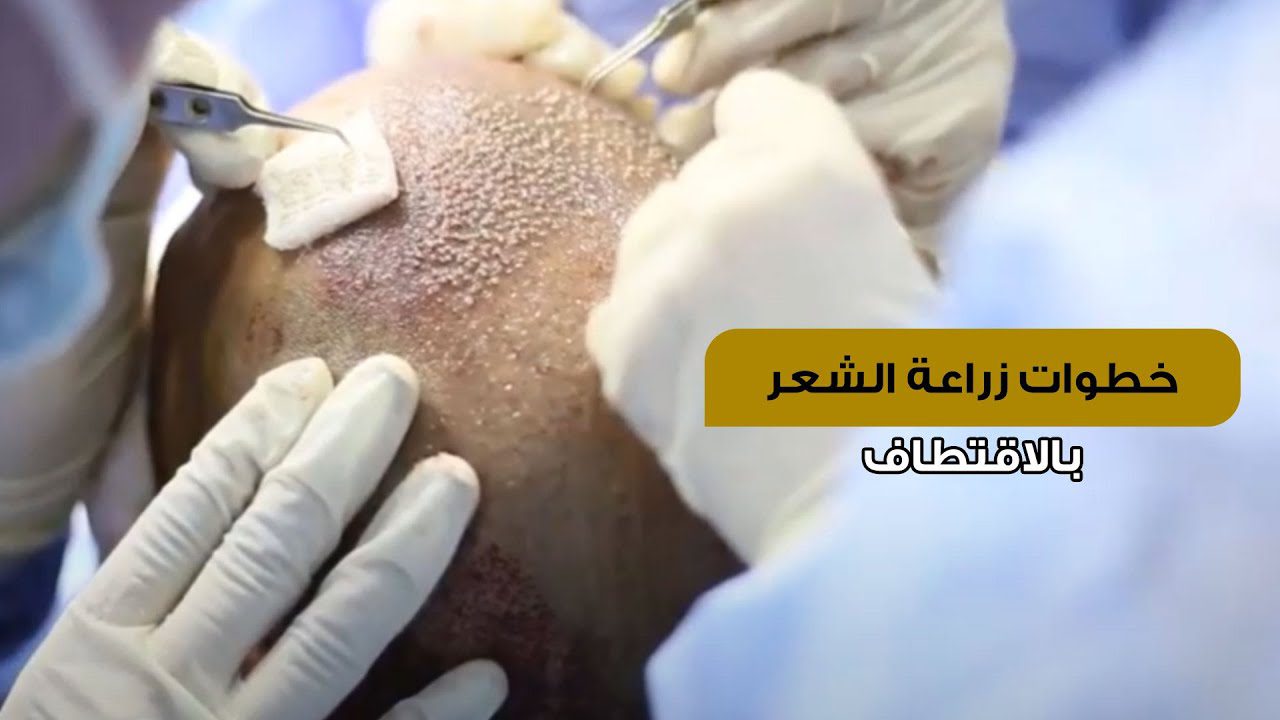 خطوات زراعة الشعر الطبيعي بالاقتطاف