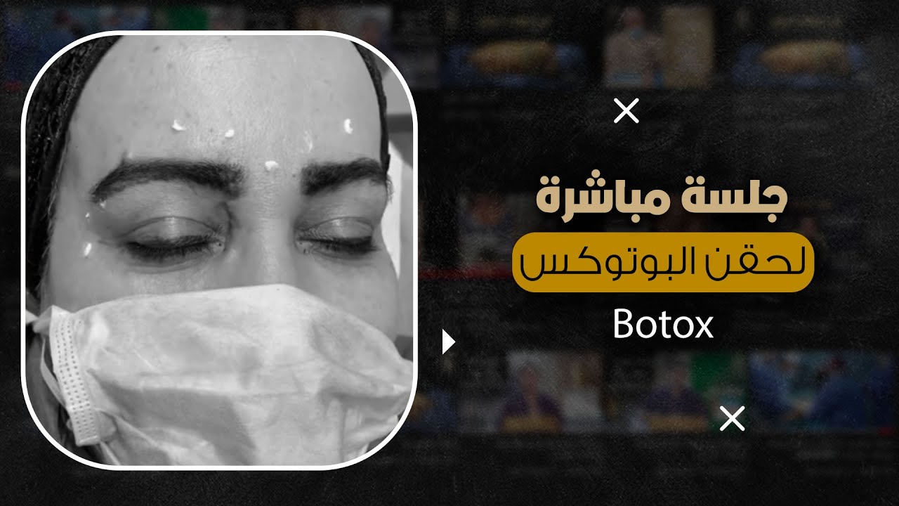 جلسة مباشرة لحقن البوتوكس
