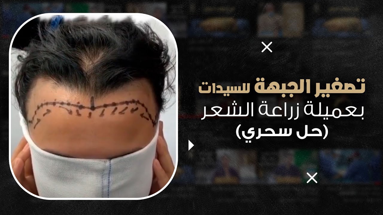 تصغير-الجبهة-للسيدات