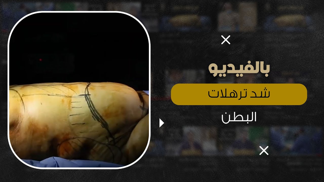 التخلص من ترهلات البطن بدون مجهود وبدون ألم