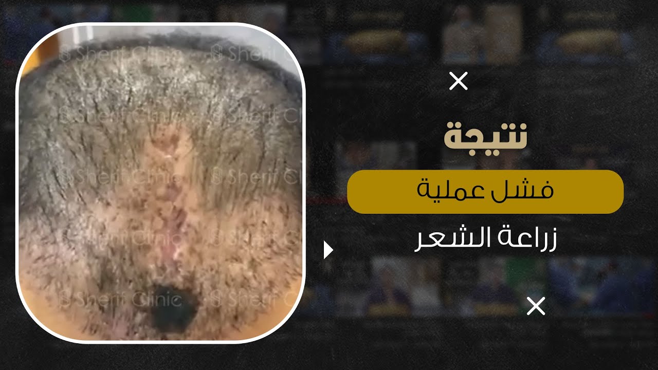 اصلاح عملية زراعة شعر فاشلة مباشرة