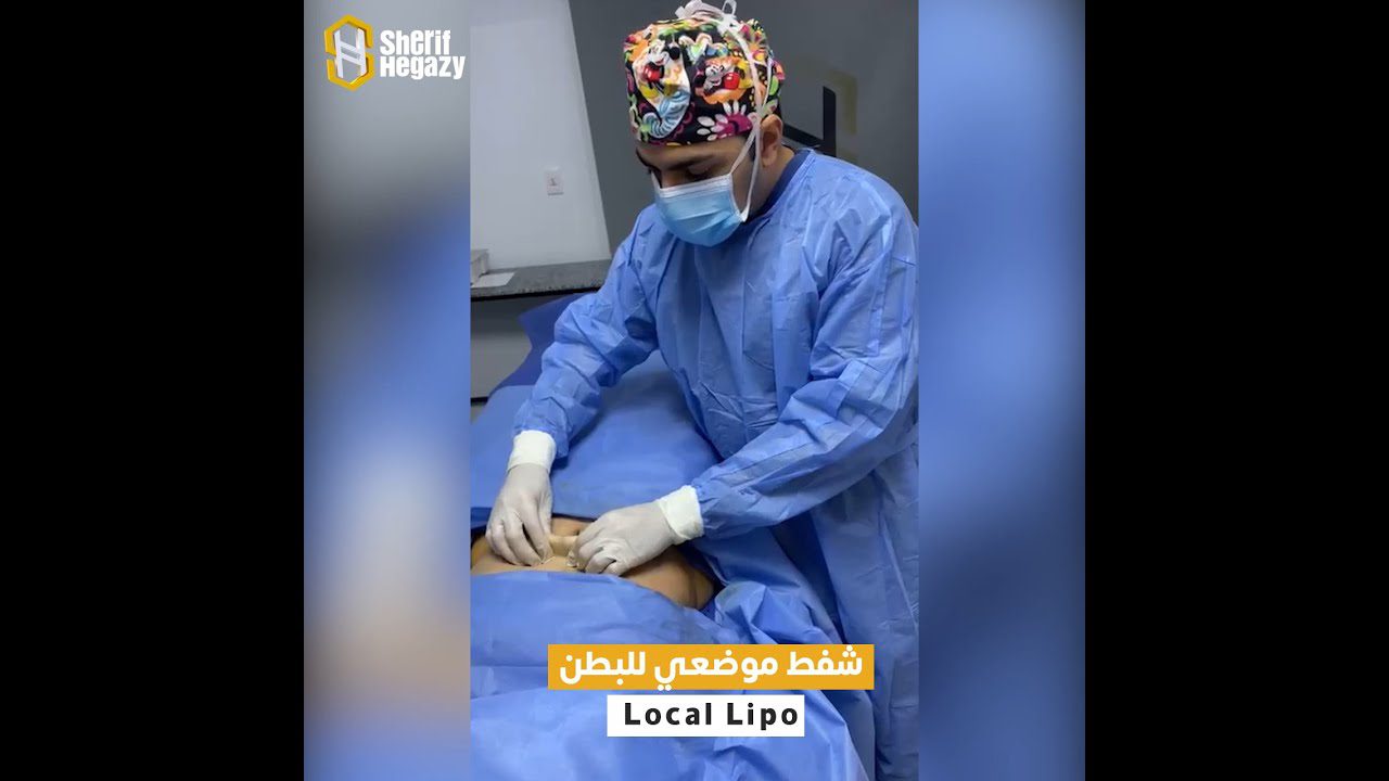 جلسة شفط موضعي للدهون بالتخدير الموضعي