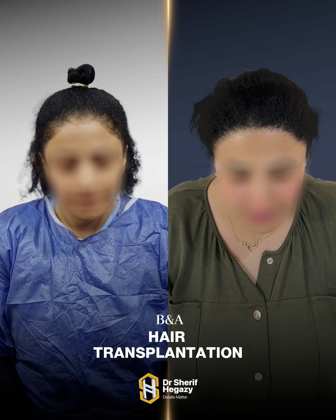 before and after hair transplant