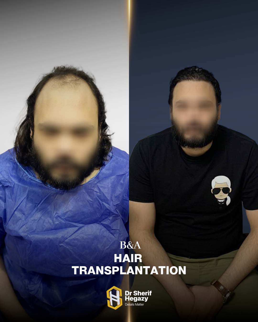 before and after hair transplant