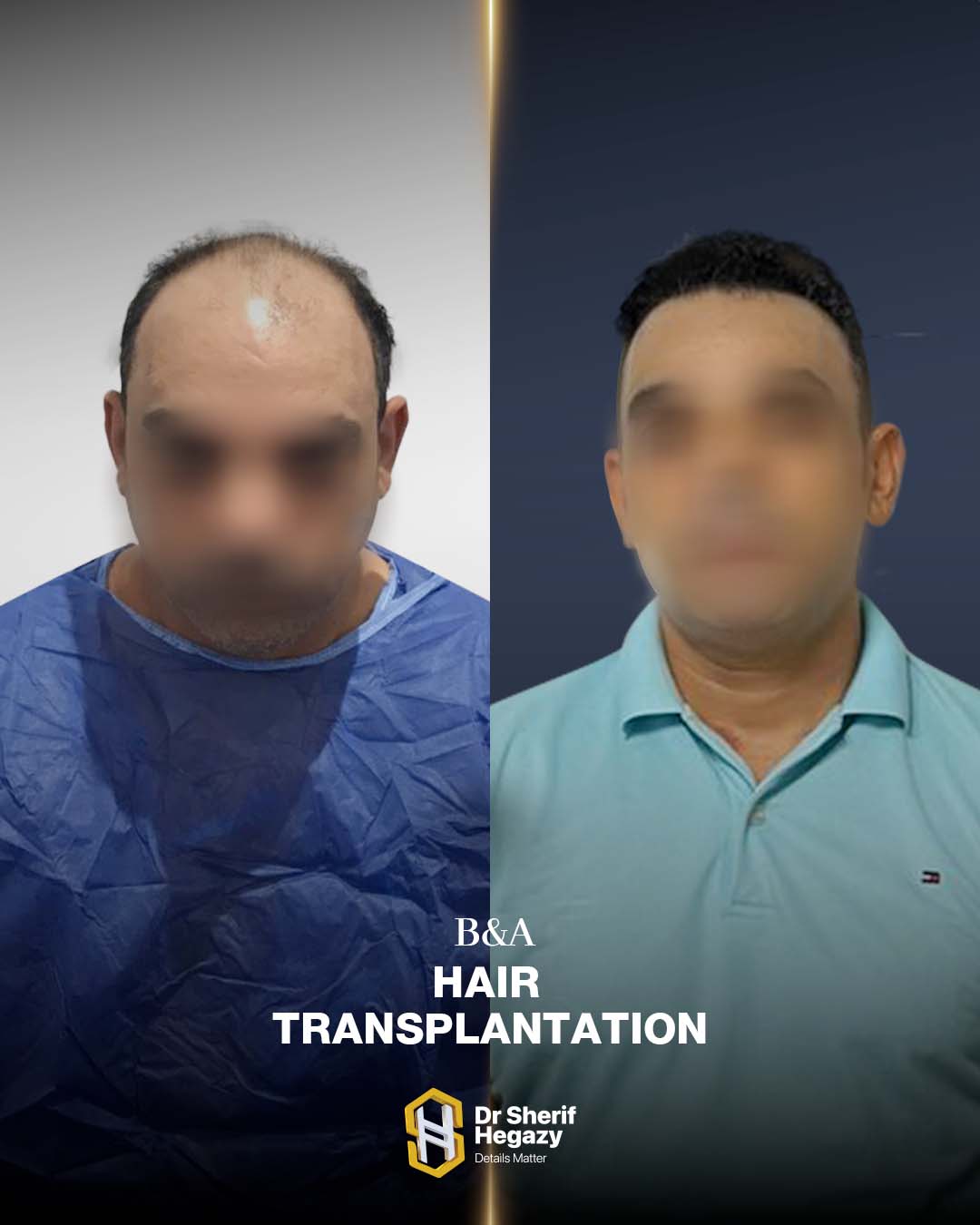 before and after hair transplant
