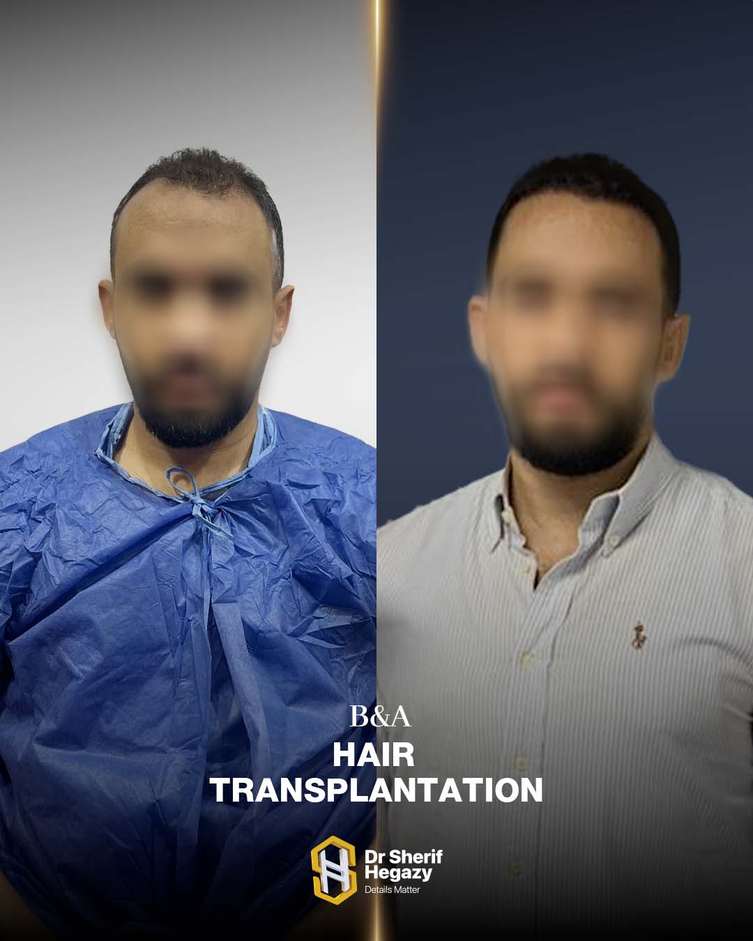 before and after hair transplant