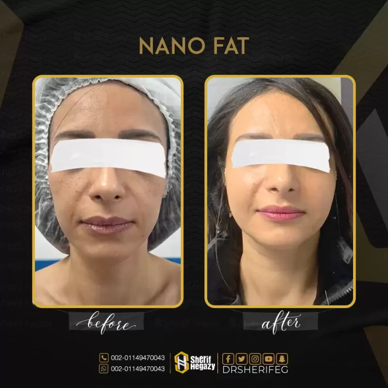 تقنية النانو فات في جراحات التجميل