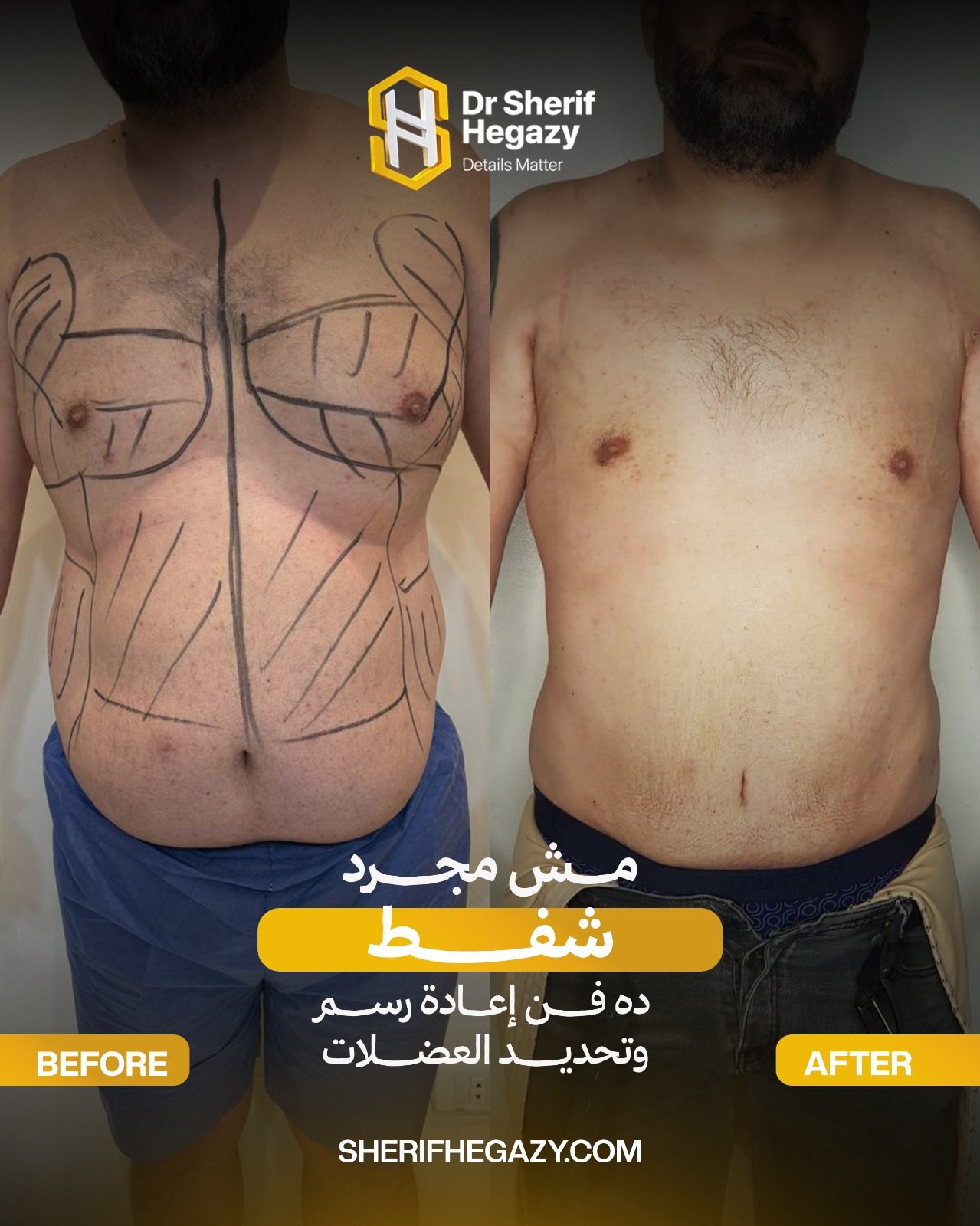 سعر شفط الدهون