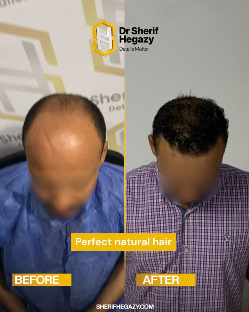 hair transplant