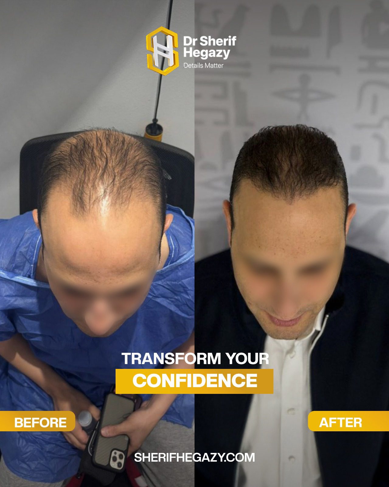 بعد و قبل زراعة الشعر