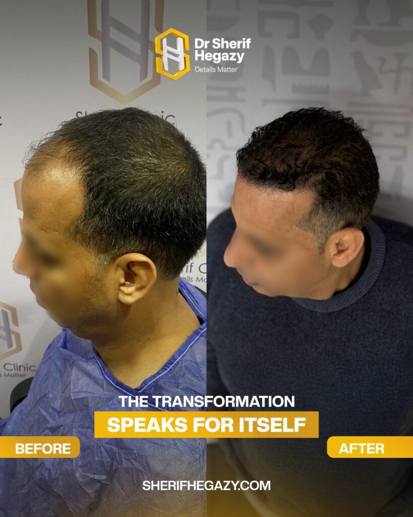 hair transplant