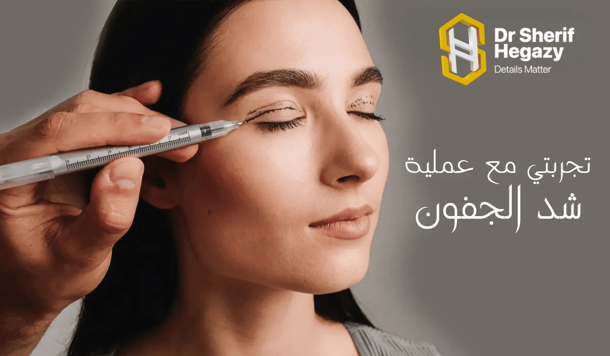 عملية شد الجفون