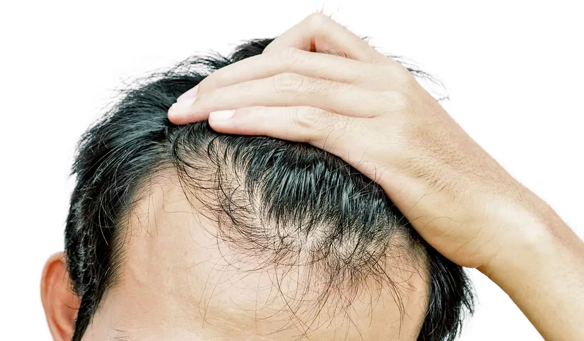 أدوية تساقط الشعر