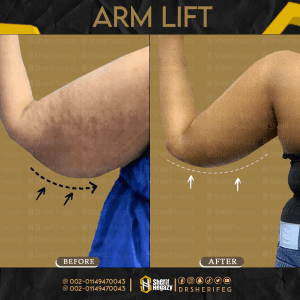 Arm Liposuction and Lift in 4 Steps