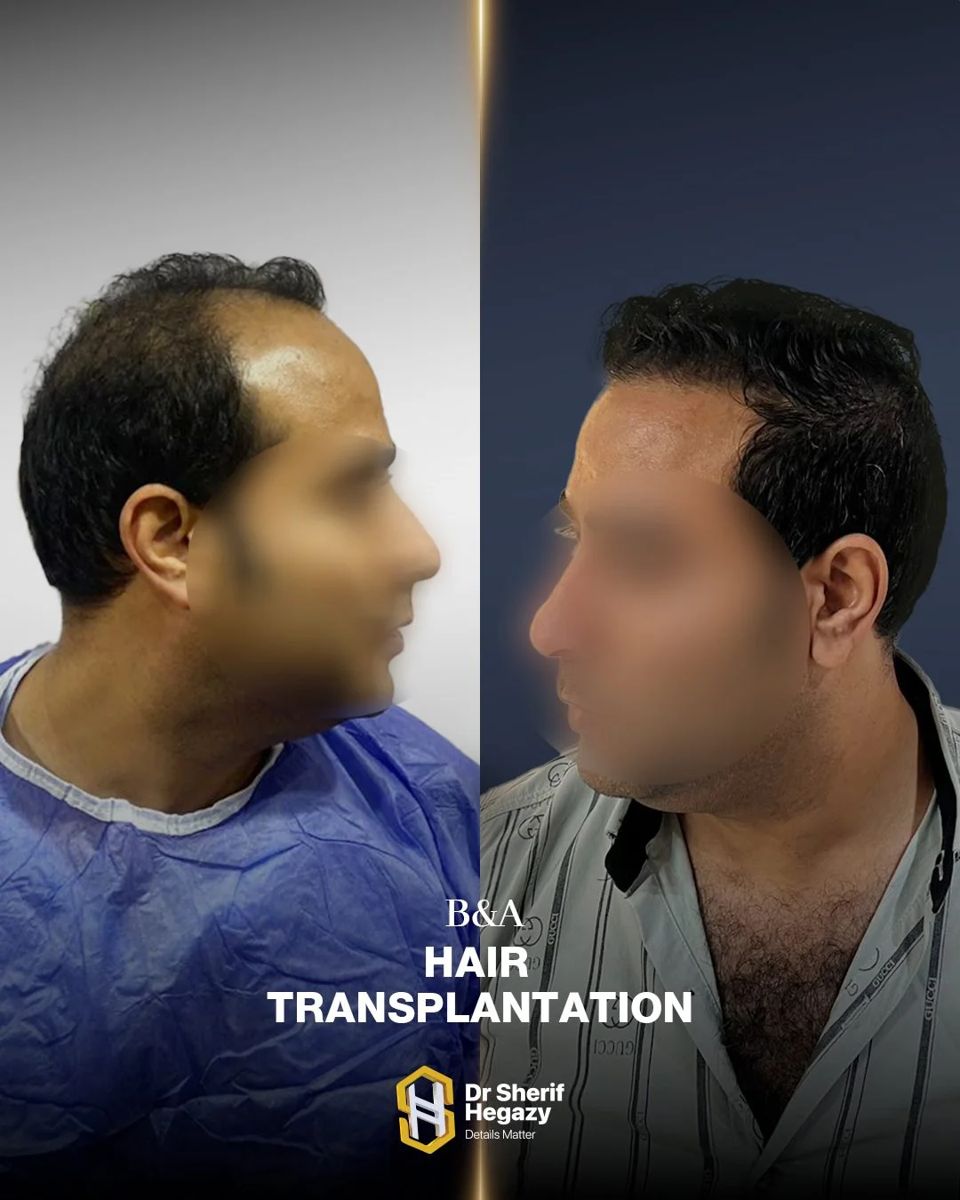 نتيجة زراعة الشعر قبل وبعد في شريف كلينك