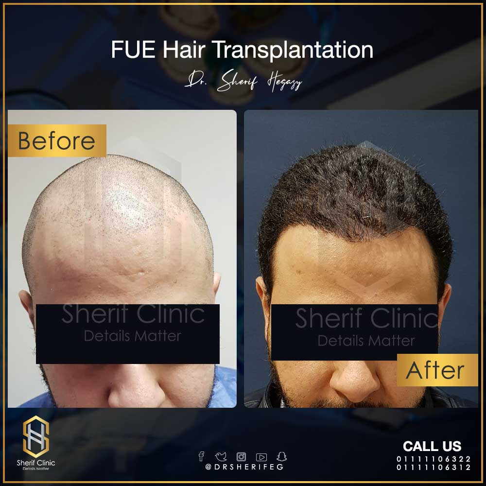 Expected Hair Transplant Results: When Do They Appear and How to Keep Them?