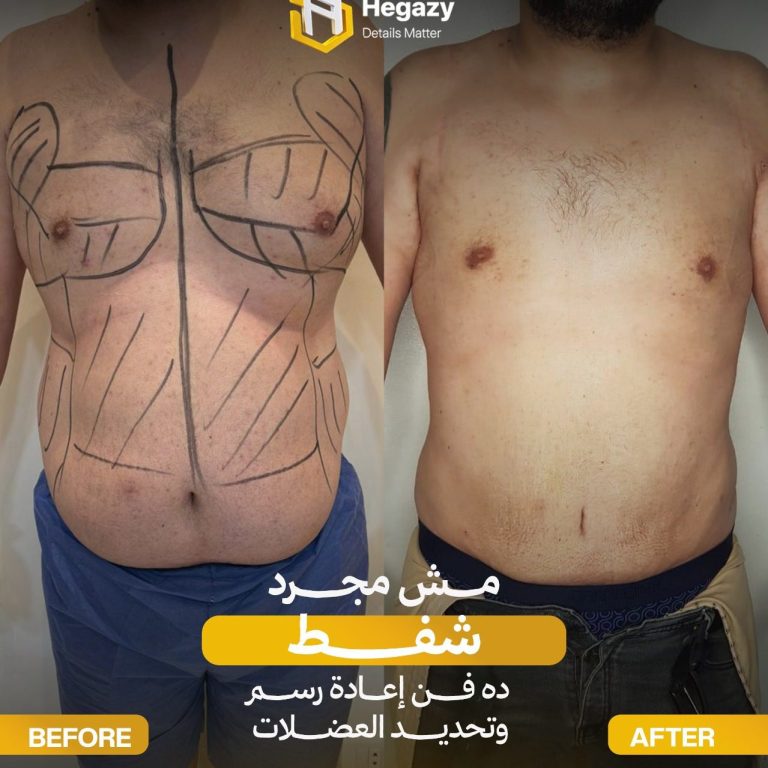 سعر شفط الدهون