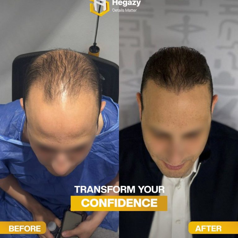 بعد و قبل زراعة الشعر