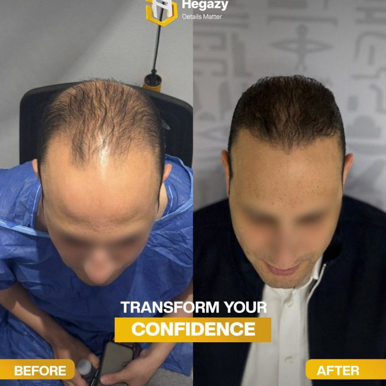 بعد و قبل زراعة الشعر