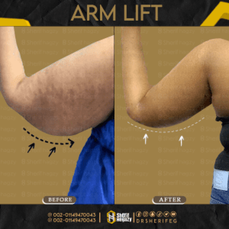 Arm Liposuction and Lift in 4 Steps