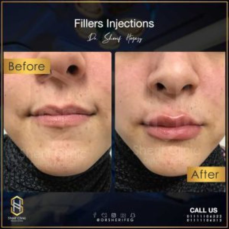 Filler Injection Risks and What to Expect