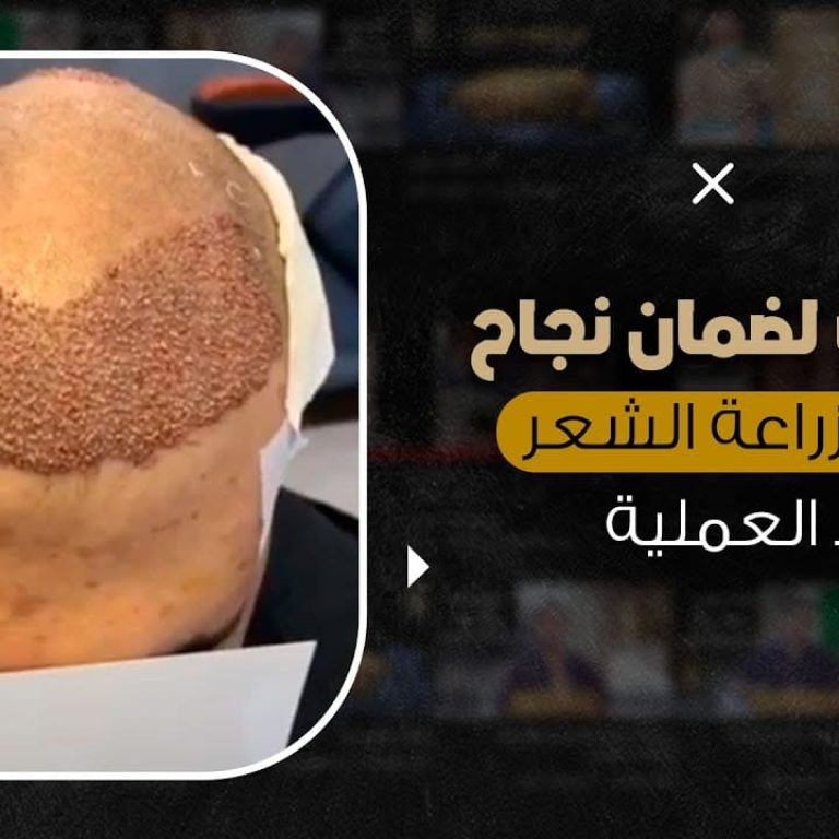 إليك بعض خطوات لضمان نجاح عملية زراعة الشعر بعد العملية