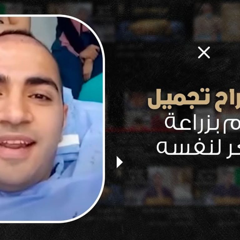 أول دكتور زراعة شعر يزرع لنفسه شاهد الفيديو من داخل العمليات