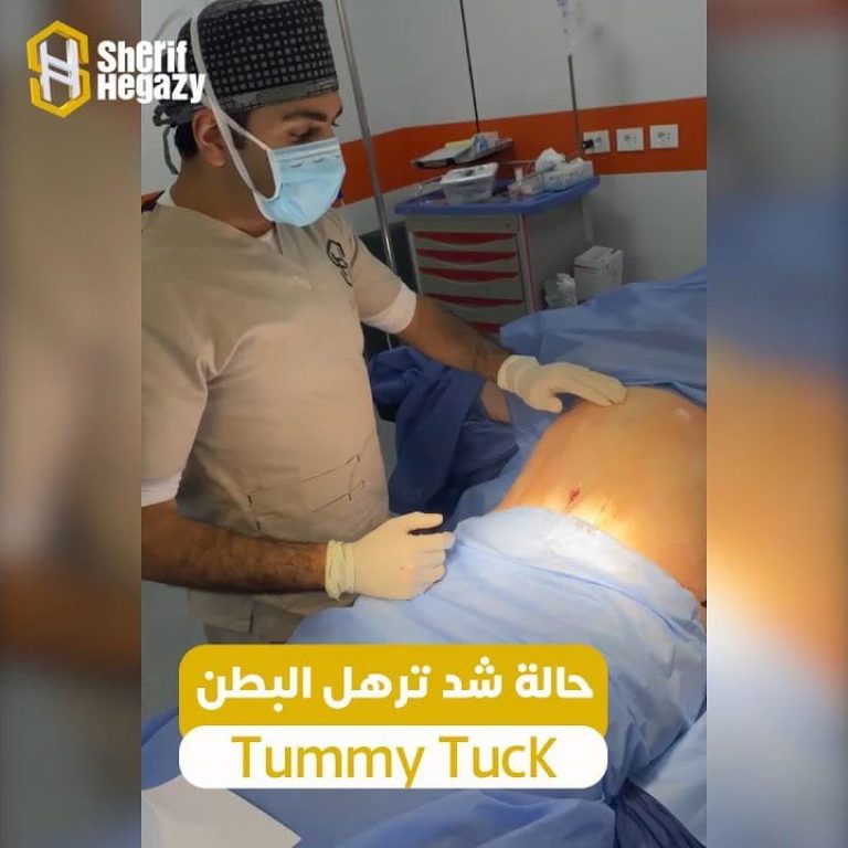 حالة شد ترهل البطن