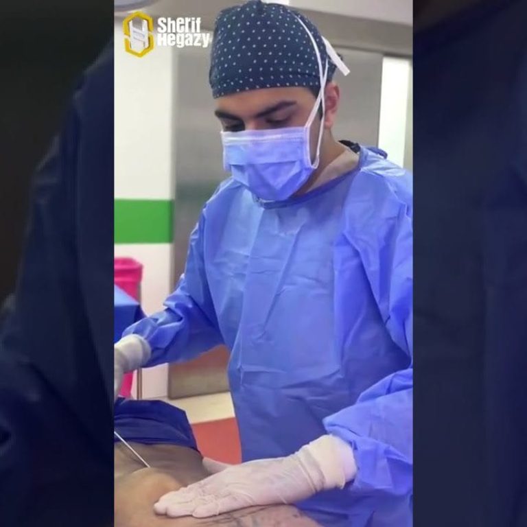نحت الجسم الديناميكي للرجال وإزالة التثدي بشكل نهائي