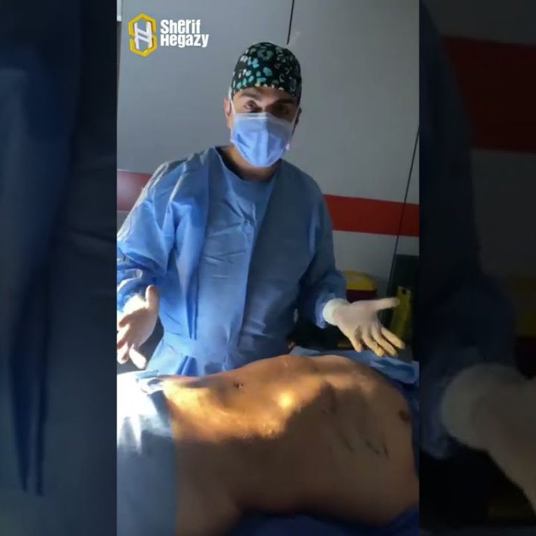 شاهد نتيجة التخلص من دهون البطن والاجناب الموضعي بنحت عالي التحديد