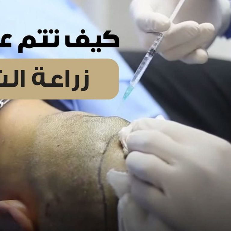 من داخل العمليات خطوات عملية زراعة الشعر