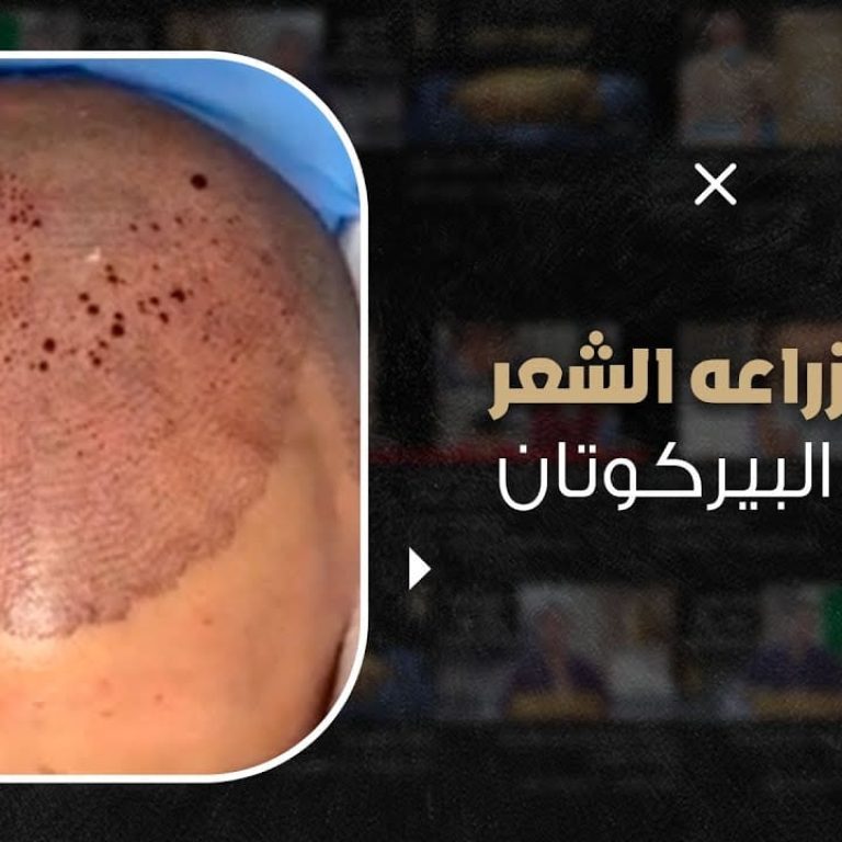 زراعة الشعر في أقل وقت ممكن بأحدث تقنيات زراعة الشعر في العالم