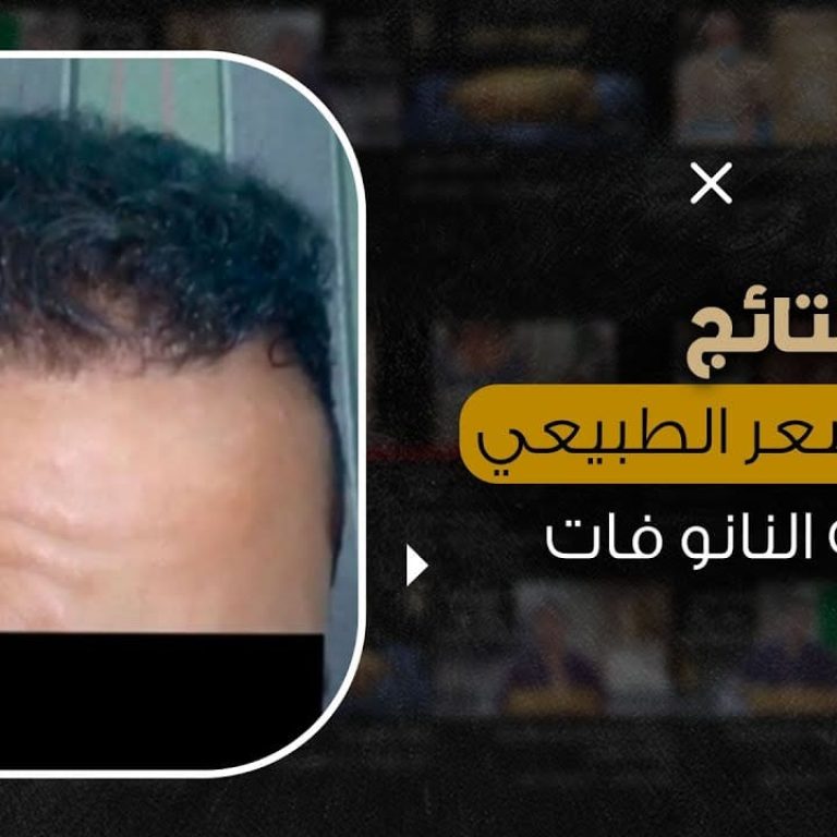 ماذا بعد زراعة الشعر بتقنية النانو فات
