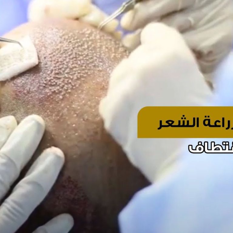 خطوات زراعة الشعر الطبيعي بالاقتطاف