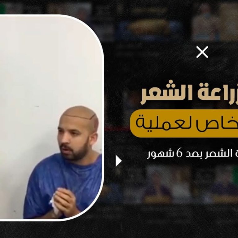 تجربة زراعة الشعر وتقييم خاص لعملية تصحيح زراعة الشعر بعد 6 شهور