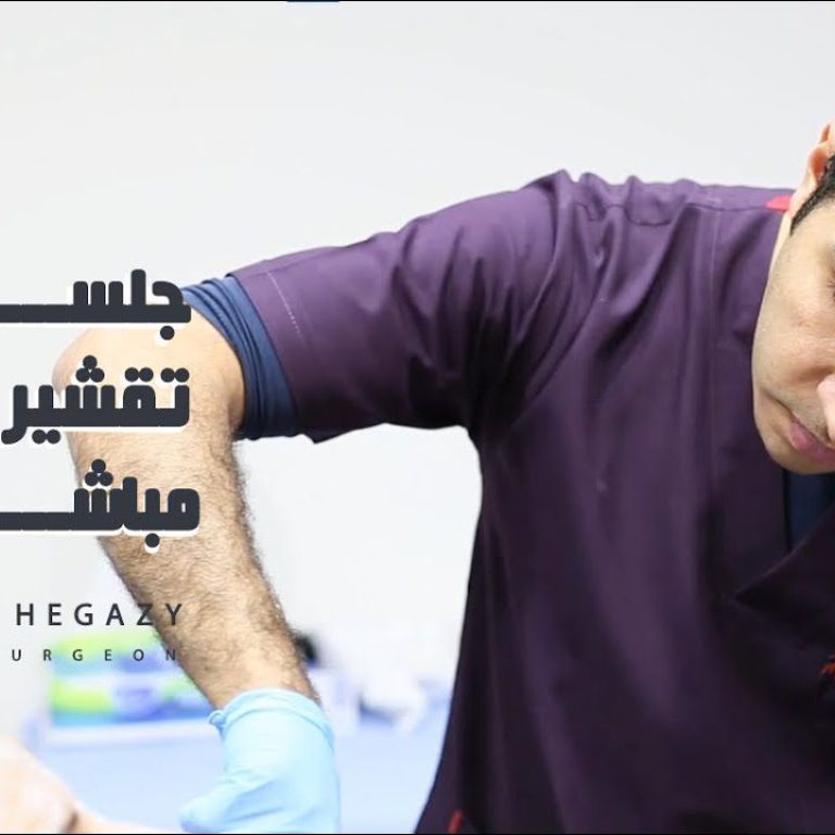 جلسة تقشير مباشرة
