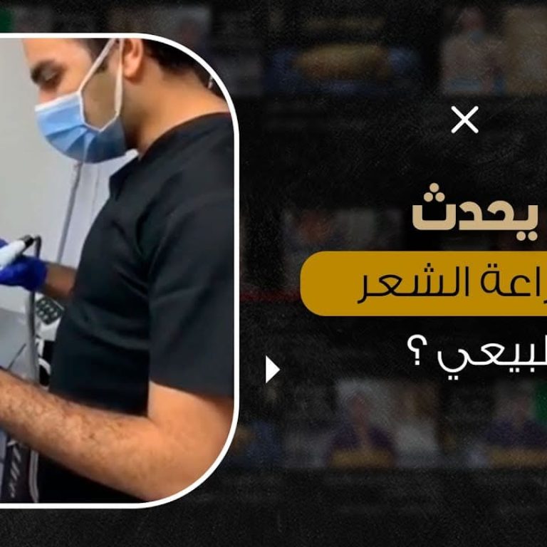 ما يحدث قبل زراعة الشعر