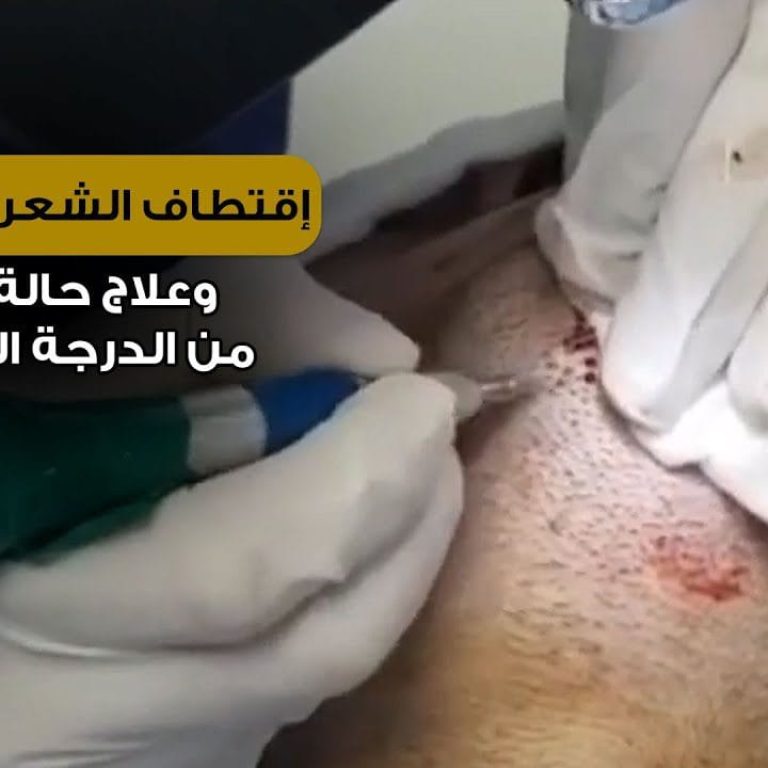 إقتطاف الشعر من الذقن وعلاج حالة صلع من الدرجة السابعة